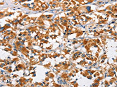The image on the left is immunohistochemistry of paraffin-embedded Human thyroid cancer tissue using the antibody Antibody) at dilution 1/50, on the right is treated with fusion protein. (Original magnification: ×200)Rabbit anti-Human DKK3 Polyclonal Antibody