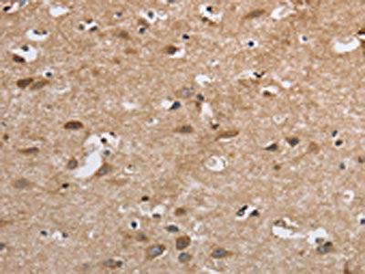 The image on the left is immunohistochemistry of paraffin-embedded Human brain tissue using SDCCAG3 Antibody(SDCCAG3 Antibody) at dilution 1/30, on the right is treated with fusion protein. (Original magnification: ×200)Rabbit anti-Human SDCCAG3 Polyclonal Antibody