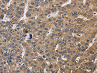 The image on the left is immunohistochemistry of paraffin-embedded Human liver cancer tissue using the antibody Antibody) at dilution 1/30, on the right is treated with fusion protein. (Original magnification: ×200)Rabbit anti-Human SDCCAG3 Polyclonal Antibody