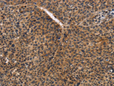 The image on the left is immunohistochemistry of paraffin-embedded Human liver cancer tissue using CDC34 Antibody(CDC34 Antibody) at dilution 1/50, on the right is treated with synthetic peptide. (Original magnification: ×200)Rabbit anti-Human CDC34 Polyclonal Antibody