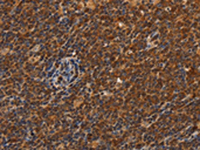 The image on the left is immunohistochemistry of paraffin-embedded Human Lymphoma tissue using the antibody Antibody) at dilution 1/50, on the right is treated with synthetic peptide. (Original magnification: ×200)Rabbit anti-Human CDC34 Polyclonal Antibody
