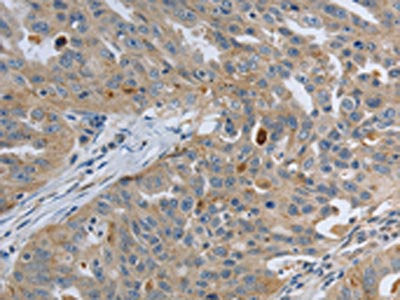 The image on the left is immunohistochemistry of paraffin-embedded Human ovarian cancer tissue using PAK4 Antibody(PAK4 Antibody) at dilution 1/20, on the right is treated with fusion protein. (Original magnification: ×200)Rabbit anti-Human PAK4 Polyclonal Antibody