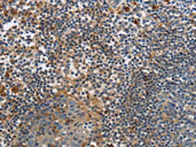 The image on the left is immunohistochemistry of paraffin-embedded Human tonsil tissue using the antibody Antibody) at dilution 1/20, on the right is treated with fusion protein. (Original magnification: ×200)Rabbit anti-Human PAK4 Polyclonal Antibody