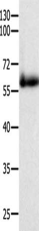 Gel: 10%SDS-PAGE, Lysate: 40 μg, Lane: Human colon cancer tissue, Primary antibody: PAK4 Antibody(PAK4 Antibody) at dilution 1/300, Secondary antibody: Goat anti rabbit IgG at 1/8000 dilution, Exposure time: 2 minutesRabbit anti-Human PAK4 Polyclonal Antibody