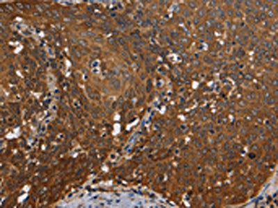 The image on the left is immunohistochemistry of paraffin-embedded Human cervical cancer tissue using the antibody Antibody) at dilution 1/50, on the right is treated with fusion protein. (Original magnification: ×200)Rabbit anti-Human REL Polyclonal Antibody