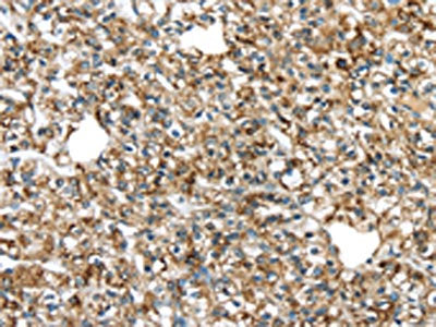 The image on the left is immunohistochemistry of paraffin-embedded Human prostate cancer tissue using the antibody Antibody) at dilution 1/20, on the right is treated with fusion protein. (Original magnification: ×200)Rabbit anti-Human TGM4 Polyclonal Antibody