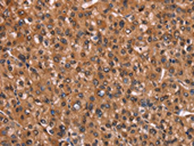 The image on the left is immunohistochemistry of paraffin-embedded Human liver cancer tissue using HINT1 Antibody(HINT1 Antibody) at dilution 1/30, on the right is treated with synthetic peptide. (Original magnification: ×200)Rabbit anti-Human HINT1 Polyclonal Antibody