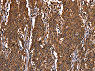 The image on the left is immunohistochemistry of paraffin-embedded Human gastic cancer tissue using the antibody Antibody) at dilution 1/30, on the right is treated with synthetic peptide. (Original magnification: ×200)Rabbit anti-Human HINT1 Polyclonal Antibody