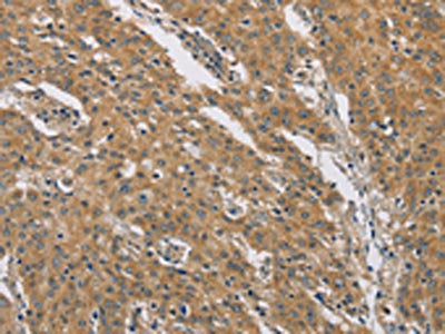 The image on the left is immunohistochemistry of paraffin-embedded Human gastric cancer tissue using DCTN1 Antibody(DCTN1 Antibody) at dilution 1/60, on the right is treated with fusion protein. (Original magnification: ×200)Rabbit anti-Human DCTN1 Polyclonal Antibody