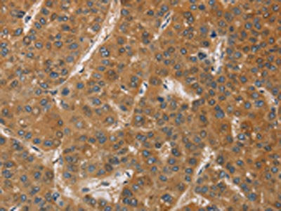 The image on the left is immunohistochemistry of paraffin-embedded Human liver cancer tissue using the antibody Antibody) at dilution 1/60, on the right is treated with fusion protein. (Original magnification: ×200)Rabbit anti-Human DCTN1 Polyclonal Antibody