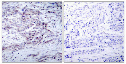 Immunohistochemical analysis of paraffin-embedded human breast carcinoma tissue using NF-κB p100(phospho- Ser870) antibody.Rabbit anti-Human NFKB2 Polyclonal Antibody
