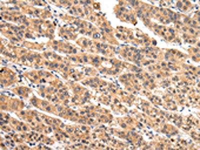 The image on the left is immunohistochemistry of paraffin-embedded Human liver cancer tissue using VIL1 Antibody(VIL1 Antibody) at dilution 1/30, on the right is treated with fusion protein. (Original magnification: ×200)Rabbit anti-Human VIL1 Polyclonal Antibody