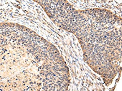 The image on the left is immunohistochemistry of paraffin-embedded Human esophagus cancer tissue using the antibody Antibody) at dilution 1/30, on the right is treated with fusion protein. (Original magnification: ×200)Rabbit anti-Human VIL1 Polyclonal Antibody