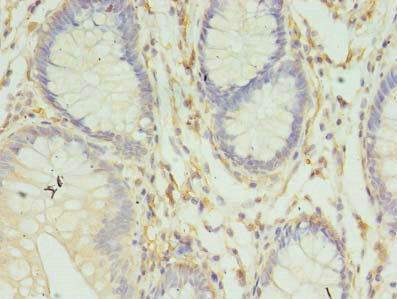 Immunohistochemistry of paraffin-embedded human colon cancer using HLA-DRB4 Antibody at dilution of 1:100Rabbit anti-Human HLA-DRB4 Polyclonal Antibody