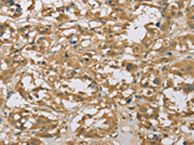 The image on the left is immunohistochemistry of paraffin-embedded Human thyroid cancer tissue using EIF6 Antibody(EIF6 Antibody) at dilution 1/20, on the right is treated with fusion protein. (Original magnification: ×200)Rabbit anti-Human EIF6 Polyclonal Antibody