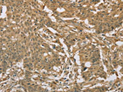 The image on the left is immunohistochemistry of paraffin-embedded Human gastic cancer tissue using the antibody Antibody) at dilution 1/20, on the right is treated with fusion protein. (Original magnification: ×200)Rabbit anti-Human EIF6 Polyclonal Antibody