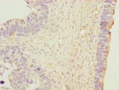 Immunohistochemistry of paraffin-embedded human ovarian cancer using DNAJB1 Antibody at dilution of 1:100Rabbit anti-Human DNAJB1 Polyclonal Antibody