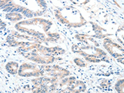 The image on the left is immunohistochemistry of paraffin-embedded Human colon cancer tissue using ALDH1A2 Antibody(ALDH1A2 Antibody) at dilution 1/60, on the right is treated with synthetic peptide. (Original magnification: ×200)Rabbit anti-Human ALDH1A2 Polyclonal Antibody