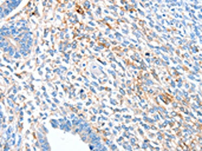 The image on the left is immunohistochemistry of paraffin-embedded Human ovarian cancer tissue using the antibody Antibody) at dilution 1/60, on the right is treated with synthetic peptide. (Original magnification: ×200)Rabbit anti-Human ALDH1A2 Polyclonal Antibody