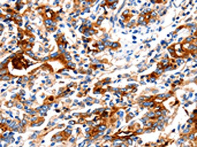 The image on the left is immunohistochemistry of paraffin-embedded Human gastric cancer tissue using KLK15 Antibody(KLK15 Antibody) at dilution 1/15, on the right is treated with fusion protein. (Original magnification: ×200)