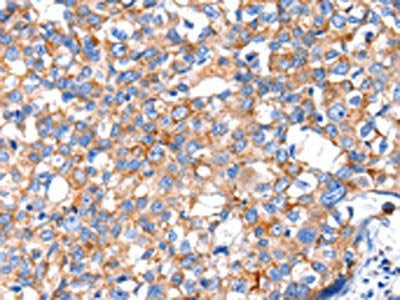 The image on the left is immunohistochemistry of paraffin-embedded Human breast cancer tissue using the antibody Antibody) at dilution 1/15, on the right is treated with fusion protein. (Original magnification: ×200)