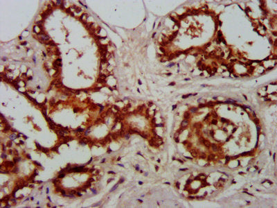 IHC image of RELA Antibody diluted at 1:600 and staining in paraffin-embedded human breast cancer performed on a Leica BondTM system. After dewaxing and hydration, antigen retrieval was mediated by high pressure in a citrate buffer (pH 6.0). Section was blocked with 10% normal goat serum 30min at RT. Then primary antibody (1% BSA) was incubated at 4°C overnight. The primary is detected by a biotinylated secondary antibody and visualized using an HRP conjugated SP system.Rabbit anti-Human RELA Polyclonal Antibody
