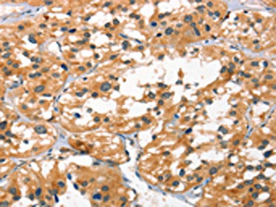 The image on the left is immunohistochemistry of paraffin-embedded Human thyroid cancer tissue using SMAD3 Antibody(SMAD3 Antibody) at dilution 1/25, on the right is treated with synthetic peptide. (Original magnification: ×200)Rabbit anti-Human SMAD3 Polyclonal Antibody