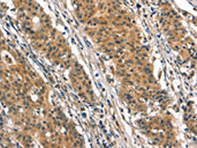 The image on the left is immunohistochemistry of paraffin-embedded Human gastic cancer tissue using the antibody Antibody) at dilution 1/25, on the right is treated with synthetic peptide. (Original magnification: ×200)Rabbit anti-Human SMAD3 Polyclonal Antibody