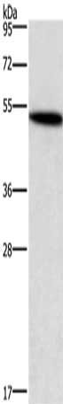 Gel: 8%SDS-PAGE, Lysate: 40 μg, Lane: Human kidney cancer tissue, Primary antibody: SMAD3 Antibody(SMAD3 Antibody) at dilution 1/400, Secondary antibody: Goat anti rabbit IgG at 1/8000 dilution, Exposure time: 1 minuteRabbit anti-Human SMAD3 Polyclonal Antibody