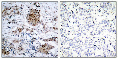 Immunohistochemical analysis of paraffin-embedded human breast carcinoma tissue using Estrogen Receptor-a(Phospho-Ser167) Antibody(left) or the same antibody preincubated with blocking peptide(right).Rabbit anti-Human ESR1 Polyclonal Antibody