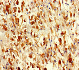 Immunohistochemistry of paraffin-embedded human melanoma using SARS Antibody at dilution of 1:100Rabbit anti-Human SARS Polyclonal Antibody