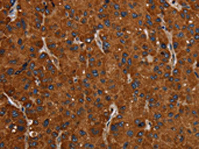 The image on the left is immunohistochemistry of paraffin-embedded Human liver cancer tissue using the antibody Antibody) at dilution 1/20, on the right is treated with synthetic peptide. (Original magnification: ×200)Rabbit anti-Human SLC22A12 Polyclonal Antibody