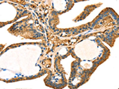 The image on the left is immunohistochemistry of paraffin-embedded Human thyroid cancer tissue using STX18 Antibody(STX18 Antibody) at dilution 1/25, on the right is treated with fusion protein. (Original magnification: ×200)Rabbit anti-Human STX18 Polyclonal Antibody