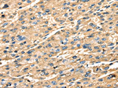 The image on the left is immunohistochemistry of paraffin-embedded Human liver cancer tissue using the antibody Antibody) at dilution 1/25, on the right is treated with fusion protein. (Original magnification: ×200)Rabbit anti-Human STX18 Polyclonal Antibody