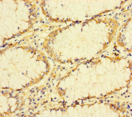 Immunohistochemistry of paraffin-embedded human colon cancer using TUBA1B Antibody at dilution of 1:100Rabbit anti-Human TUBA1B Polyclonal Antibody