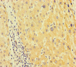 Immunohistochemistry of paraffin-embedded human liver cancer using TUBA1B Antibody at dilution of 1:100Rabbit anti-Human TUBA1B Polyclonal Antibody