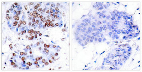 Immunohistochemical analysis of paraffin-embedded human breast carcinoma tissue using NFkB-p65(Ab-276) Antibody(left) or the same antibody preincubated with blocking peptide(right).Rabbit anti-Human RELA Polyclonal Antibody