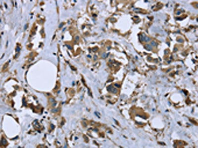 The image on the left is immunohistochemistry of paraffin-embedded Human breast cancer tissue using MYL12B Antibody(MYL12B Antibody) at dilution 1/20, on the right is treated with fusion protein. (Original magnification: ×200)Rabbit anti-Human MYL12B Polyclonal Antibody
