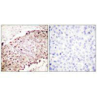Immunohistochemistry analysis of paraffin-embedded human breast carcinoma tissue using Sumo1 antibody.Rabbit anti-Human SUMO1 Polyclonal Antibody