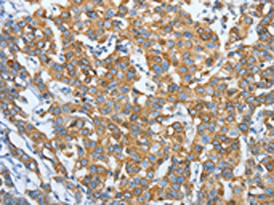 The image on the left is immunohistochemistry of paraffin-embedded Human breast cancer tissue using KRT81 Antibody(KRT81 Antibody) at dilution 1/15, on the right is treated with fusion protein. (Original magnification: ×200)
