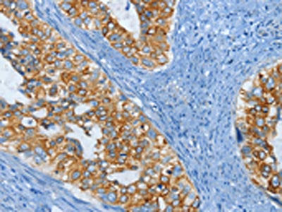 The image on the left is immunohistochemistry of paraffin-embedded Human cervical cancer tissue using the antibody Antibody) at dilution 1/15, on the right is treated with fusion protein. (Original magnification: ×200)