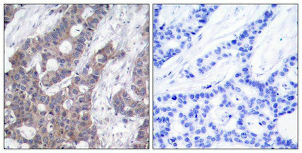 Immunohistochemical analysis of paraffin-embedded human breast carcinoma tissue using Stathmin 1(Phospho-Ser16) Antibody(left) or the same antibody preincubated with blocking peptide(right).Rabbit anti-Human STMN1 Polyclonal Antibody