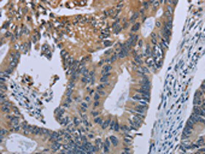 The image on the left is immunohistochemistry of paraffin-embedded Human colon cancer tissue using CEBPD Antibody(CEBPD Antibody) at dilution 1/40, on the right is treated with synthetic peptide. (Original magnification: ×200)Rabbit anti-Human CEBPD Polyclonal Antibody