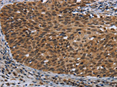 The image on the left is immunohistochemistry of paraffin-embedded Human cervical cancer tissue using the antibody Antibody) at dilution 1/40, on the right is treated with synthetic peptide. (Original magnification: ×200)Rabbit anti-Human CEBPD Polyclonal Antibody