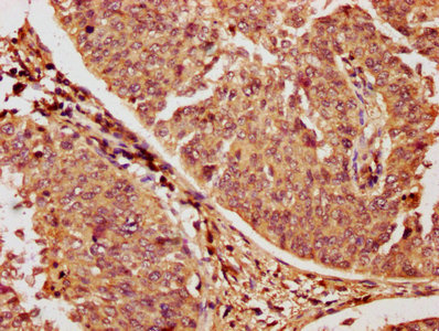 IHC image of RAC1 Antibody diluted at 1:1200 and staining in paraffin-embedded human cervical cancer performed on a Leica BondTM system. After dewaxing and hydration, antigen retrieval was mediated by high pressure in a citrate buffer (pH 6.0). Section was blocked with 10% normal goat serum 30min at RT. Then primary antibody (1% BSA) was incubated at 4°C overnight. The primary is detected by a biotinylated secondary antibody and visualized using an HRP conjugated SP system.Rabbit anti-Human RAC1 Polyclonal Antibody