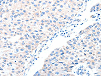 The image on the left is immunohistochemistry of paraffin-embedded Human breast cancer tissue using ADAM32 Antibody(ADAM32 Antibody) at dilution 1/15, on the right is treated with fusion protein. (Original magnification: ×200)