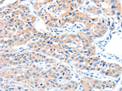 The image on the left is immunohistochemistry of paraffin-embedded Human lung cancer tissue using the antibody Antibody) at dilution 1/15, on the right is treated with fusion protein. (Original magnification: ×200)