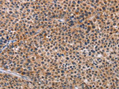The image on the left is immunohistochemistry of paraffin-embedded Human liver cancer tissue using AGPS Antibody(AGPS Antibody) at dilution 1/25, on the right is treated with fusion protein. (Original magnification: ×200)Rabbit anti-Human AGPS Polyclonal Antibody