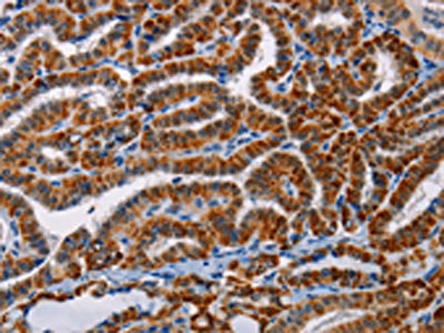 The image on the left is immunohistochemistry of paraffin-embedded Human thyroid cancer tissue using the antibody Antibody) at dilution 1/25, on the right is treated with fusion protein. (Original magnification: ×200)Rabbit anti-Human AGPS Polyclonal Antibody