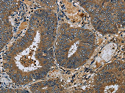 The image on the left is immunohistochemistry of paraffin-embedded Human colon cancer tissue using the antibody Antibody) at dilution 1/60, on the right is treated with fusion protein. (Original magnification: ×200)Rabbit anti-Human PAEP Polyclonal Antibody